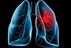 Ung thư phổi nguyên nhân và các yếu tố nguy cơ.