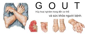 Nguyên nhân triệu chứng của bệnh Gout