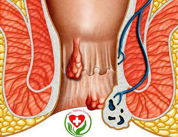 Mạch Lươn (Rò Hậu Môn): Dấu Hiệu Và Cách Điều Trị Từ A-Z