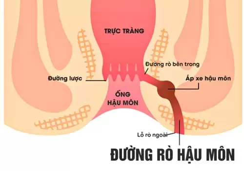 Kinh Nghiệm Chữa Rò Hậu Môn Bằng Đông Y