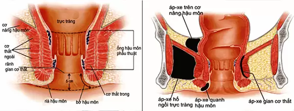 Nguyên Nhân Rò Hậu Môn
