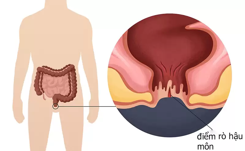 Sau Mổ Rò Hậu Môn Kiêng Gì