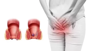 Rò Hậu Môn Có Mùi Hôi Hám Điều Trị Thế Nào ? Nguyên Nhân, Cách Chữa Quả Và Phòng Ngừa Tái Phát