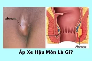 Áp Xe Hậu Môn Bảo Lâu Thì Thành Rò Hậu Môn? Dấu Hiệu Cảnh Báo Và Cách Điều Trị