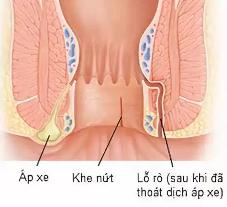 Chữa rò hậu môn đông y hay tây y
