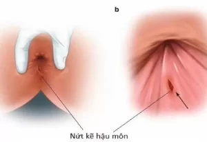 Rò Hậu Môn Trong Và Rò Hậu Môn Ngoài: Phân Biệt Chính Xác Để Điều Trị Hiệu Quả