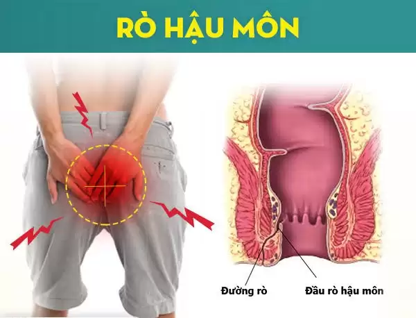 Chữa Rò Hậu Môn Có Đau Không? Giải Đáp Từ Chuyên Gia