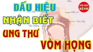 Mách bạn triệu chứng sớm của bệnh ung thư vòm họng