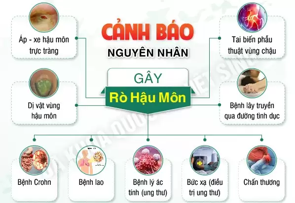 Rò Hậu Môn Giai Đoạn Đầu