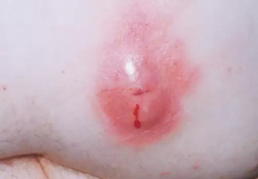 Chữa bệnh mạch lươn