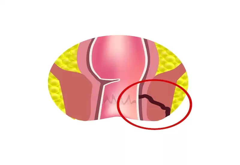 Vết rò hậu môn