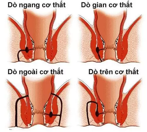 Sau Mổ Rò Hậu Môn Kiêng Gì