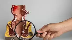 Rò Hậu Môn Có Nguy Hiểm Không