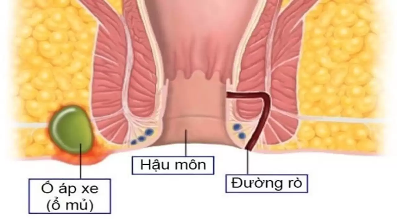 Rò Hậu Môn Kiêng Gì