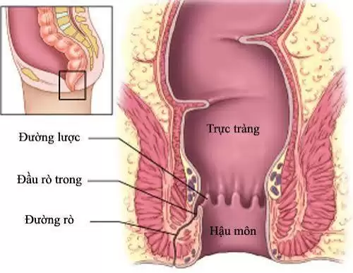 Rò Hậu Môn Là Gì