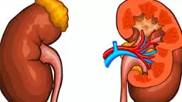 Ung thư thận triệu chứng và chẩn đoán