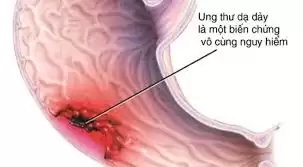 Chẩn Đoán Sớm Ung Thư Dạ Dày