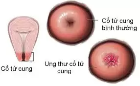 Phương pháp mới chẩn đoán sớm ung thư cổ tử cung