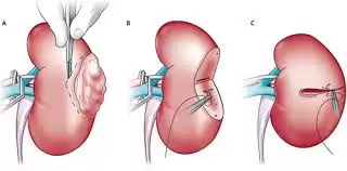 Ung thư thận và các phương pháp điều trị