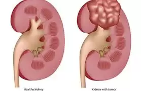 Ung thư thận nguyên nhân và cơ chế bệnh sinh