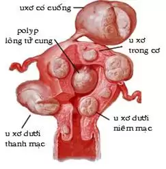 Ung thư niêm mạc tử cung