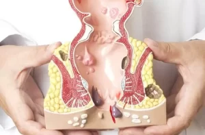 Vết Rò Hậu Môn Bị Sưng: Nguyên Nhân, Dấu Hiệu Nguy Hiểm Và Cách Xử Lý Đúng