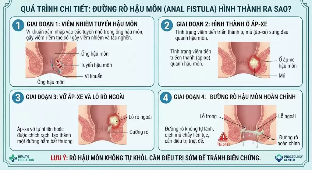 Đường rò hậu môn hình thành ra sao